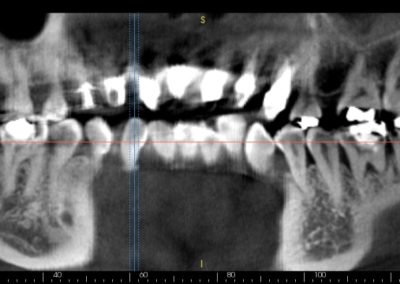CBCT Scan3